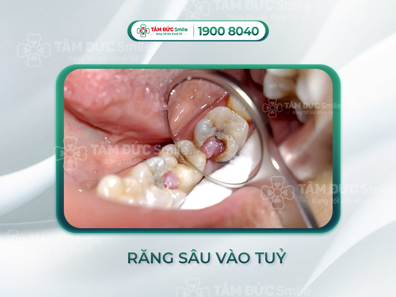 RĂNG SÂU VÀO TUỶ: DẤU HIỆU NHẬN BIẾT SỚM VÀ CÁCH CHỮA TRỊ HIỆU QUẢ