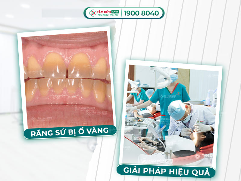 RĂNG SỨ BỊ Ố VÀNG: NGUYÊN NHÂN, CÁCH KHẮC PHỤC VÀ PHÒNG TRÁNH HIỆU QUẢ