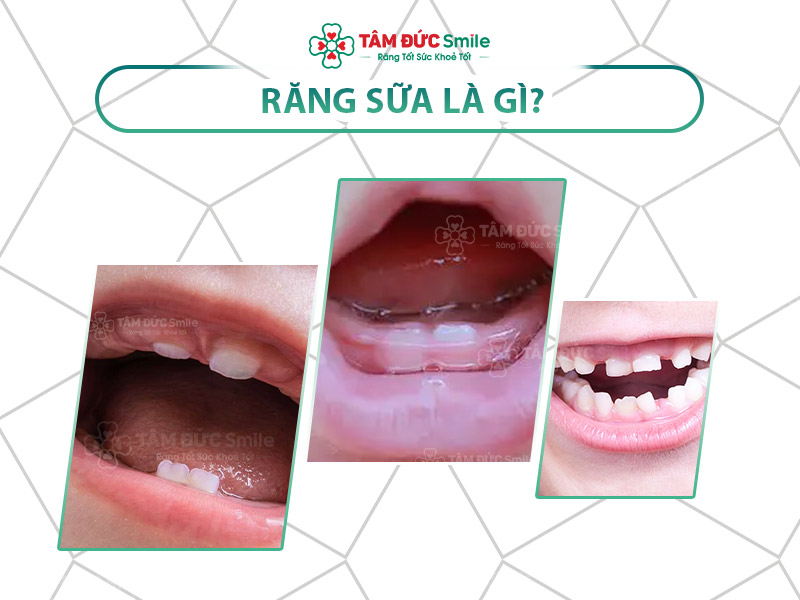 RĂNG SỮA LÀ GÌ? HƯỚNG DẪN TRẺ ĐÁNH RĂNG ĐỂ BẢO VỆ RĂNG SỮA