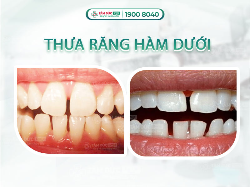 RĂNG THƯA HÀM DƯỚI PHẢI LÀM SAO?