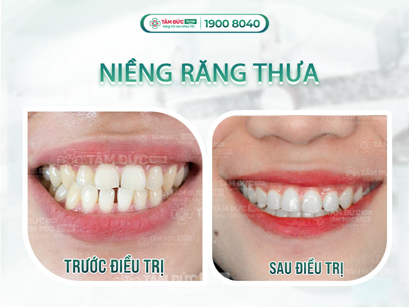 RĂNG THƯA NÊN CHỌN NIỀNG RĂNG HAY BỌC SỨ? 