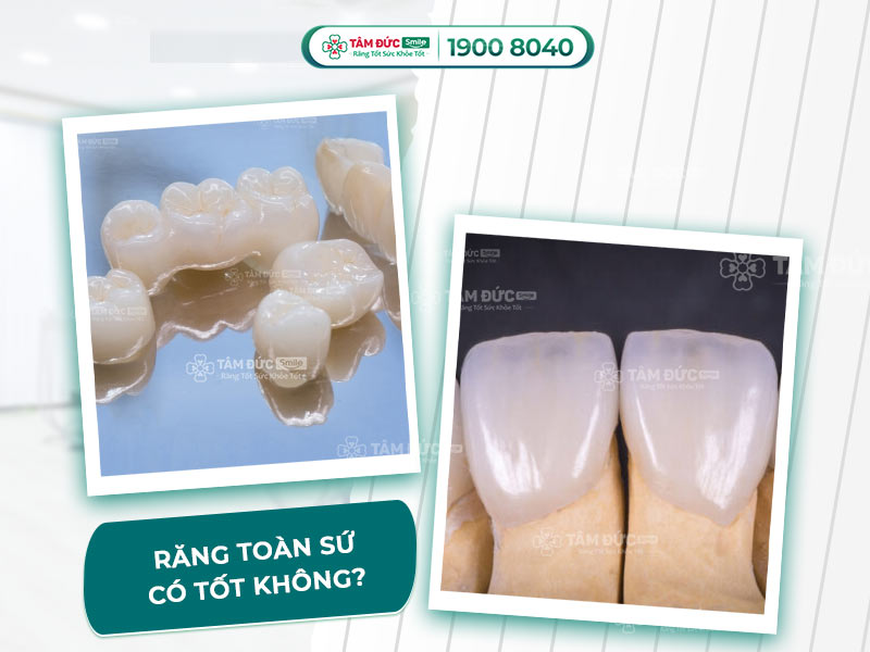 RĂNG TOÀN SỨ CERCON CÓ TỐT HAY KHÔNG?