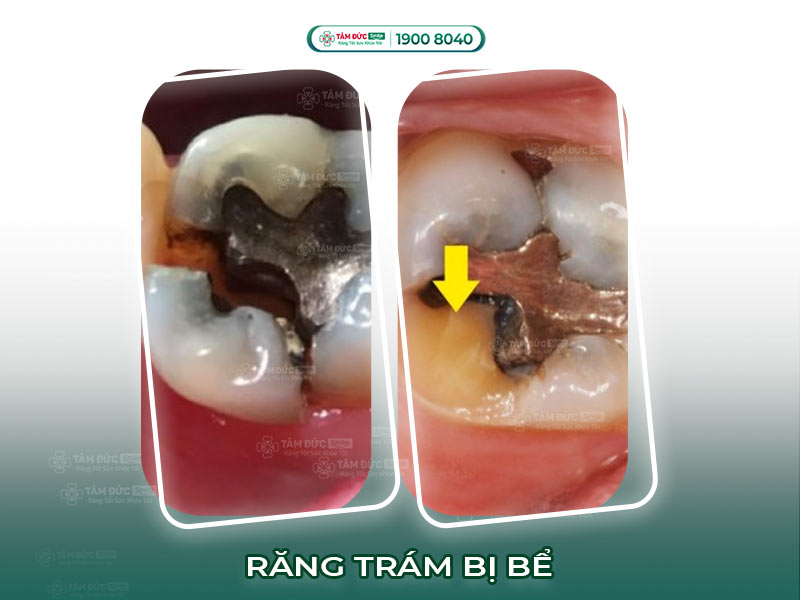 RĂNG TRÁM BỊ BỂ: NGUYÊN NHÂN, DẤU HIỆU VÀ CÁCH XỬ LÝ  HIỆU QUẢ