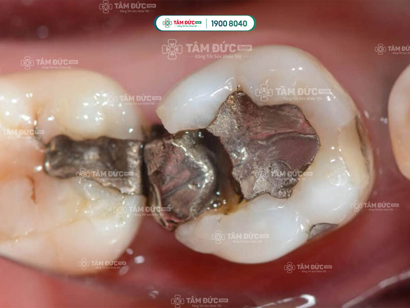 răng trám bị đau và vỡ miếng trám