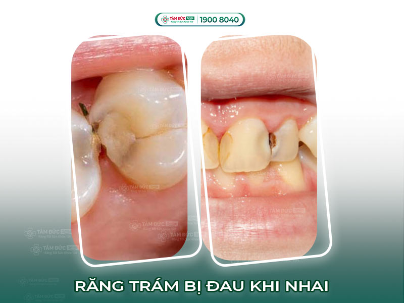 RĂNG TRÁM BỊ ĐAU KHI NHAI: NGUYÊN NHÂN VÀ CÁCH XỬ LÝ