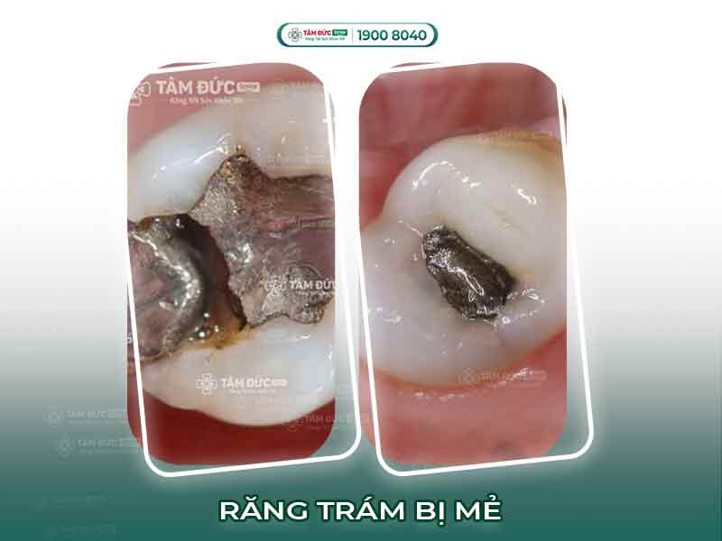 RĂNG TRÁM BỊ MẺ CÓ TRÁM LẠI ĐƯỢC KHÔNG?