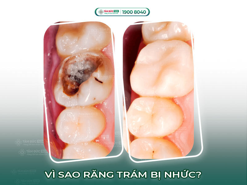 RĂNG TRÁM BỊ NHỨC: NGUYÊN NHÂN, CÁCH KHẮC PHỤC VÀ PHÒNG NGỪA