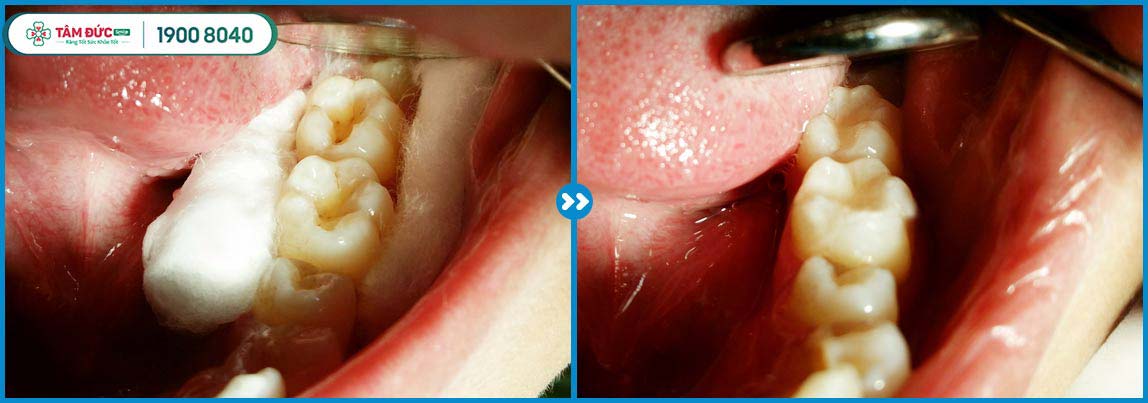 Trám răng tại Tâm Đức Smile với đội ngũ bác sĩ chuyên môn cao