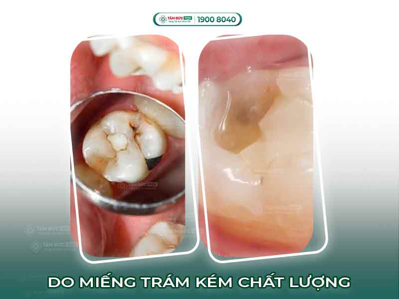 RĂNG TRÁM RỒI VẪN ĐAU: NGUYÊN NHÂN VÀ CÁCH KHẮC PHỤC