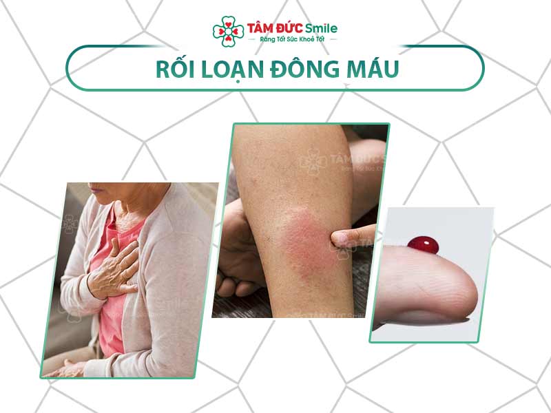 [GIẢI ĐÁP] RỐI LOẠN ĐÔNG MÁU LÀ GÌ? DẤU HIỆU NHẬN BIẾT VÀ CHẨN ĐOÁN