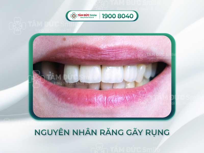 RỤNG RĂNG LÀ TRIỆU CHỨNG CỦA BỆNH GÌ? CÁCH PHÒNG TRÁNH