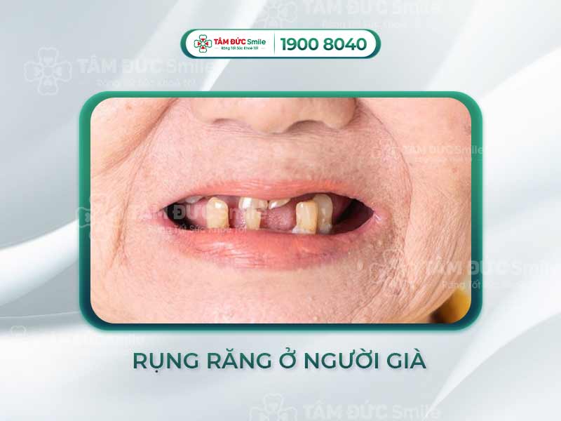 RỤNG RĂNG Ở NGƯỜI GIÀ: NGUYÊN NHÂN VÀ GIẢI PHÁP ĐẢM BẢO BỮA ĂN NGON