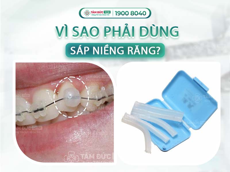 SÁP NIỀNG RĂNG LÀ GÌ? VÌ SAO PHẢI DÙNG SÁP KHI NIỀNG RĂNG