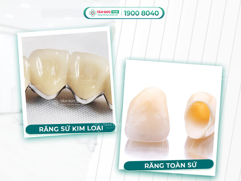 So Sánh Răng Sứ Kim Loại Và Răng Toàn Sứ