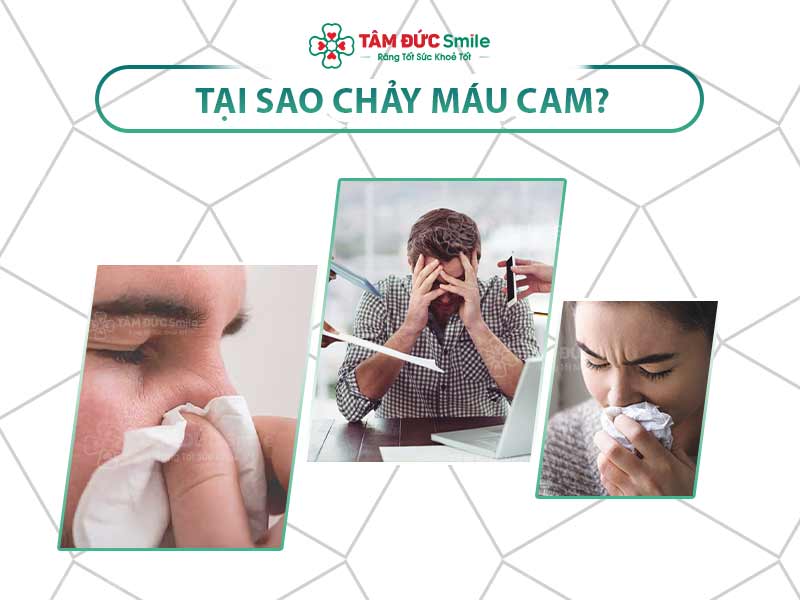 TẠI SAO BỊ CHẢY MÁU CAM? CÁCH XỬ LÝ NHANH CHÓNG VÀ AN TOÀN