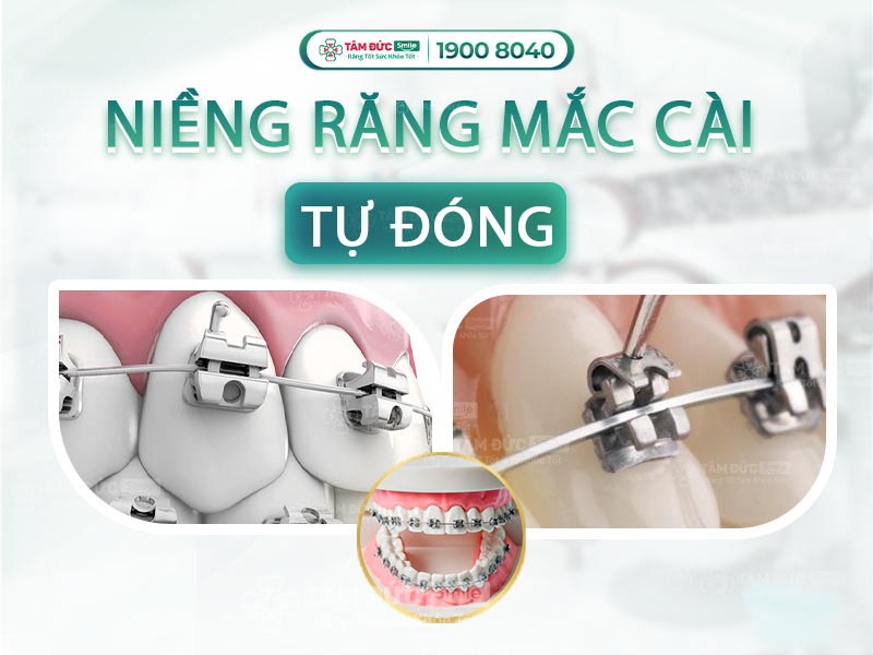 TẠI SAO CHỌN NIỀNG RĂNG MẮC CÀI TỰ ĐÓNG THAY CHO NIỀNG RĂNG MẮC CÀI THƯỜNG?