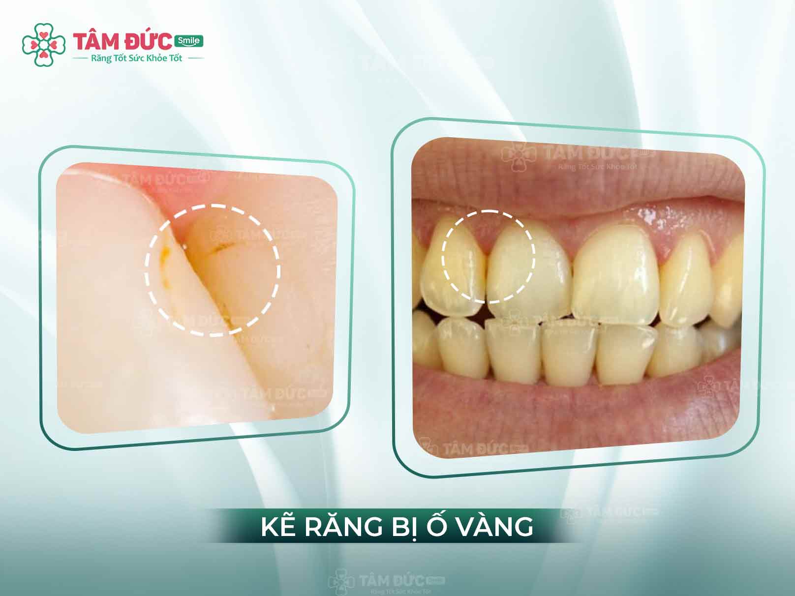 TẠI SAO KẼ RĂNG BỊ Ố VÀNG? CÁCH LOẠI BỎ MÀU RĂNG Ố VÀNG CHỈ SAU 15 PHÚT