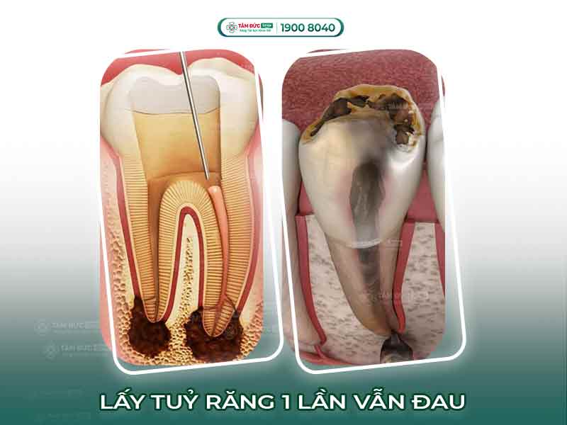 TẠI SAO LẤY TỦY RĂNG LẦN 1 VẪN CÒN ĐAU? KHẮC PHỤC NHƯ THẾ NÀO HIỆU QUẢ?