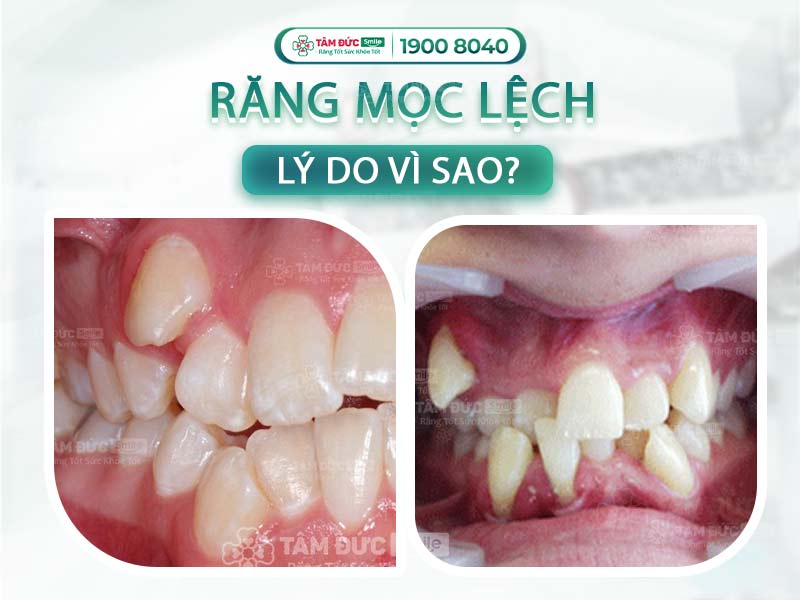 TẠI SAO RĂNG MỌC LỆCH? 2 CÁCH KHẮC PHỤC HIỆU QUẢ THỜI NAY