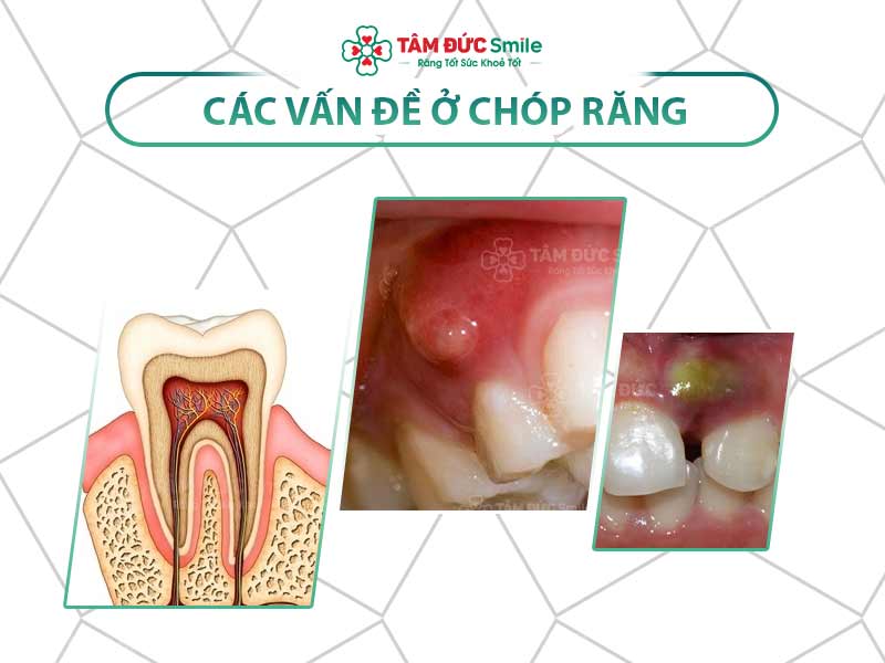 TẤT TẦN TẬT VỀ CHÓP RĂNG LÀ GÌ? CÁC VẤN ĐỀ THƯỜNG GẶP Ở CHÓP RĂNG