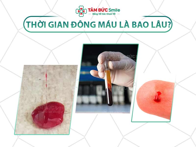 THỜI GIAN ĐÔNG MÁU LÀ GÌ? LÝ DO CẦN XÉT NGHIỆM THỜI GIAN ĐÔNG MÁU TRƯỚC KHI NHỔ RĂNG