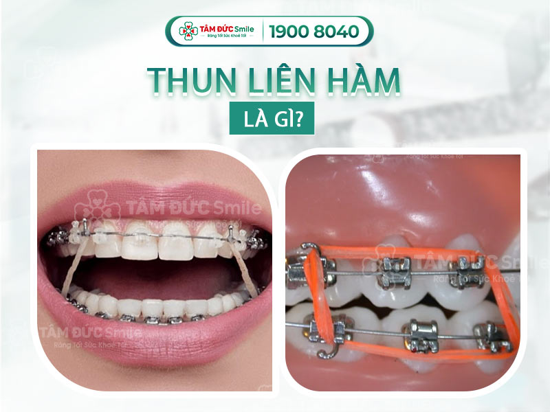 THUN LIÊN HÀM LÀ GÌ? ĐEO THUN LIÊN HÀM CÓ TÁC DỤNG GÌ?