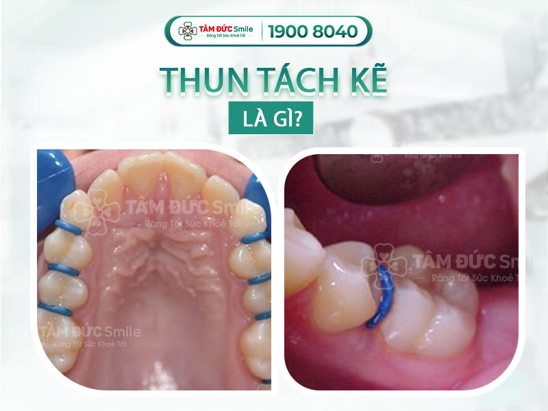 THUN TÁCH KẼ LÀ GÌ? VÌ SAO PHẢI ĐẶT THUN TÁCH KẼ