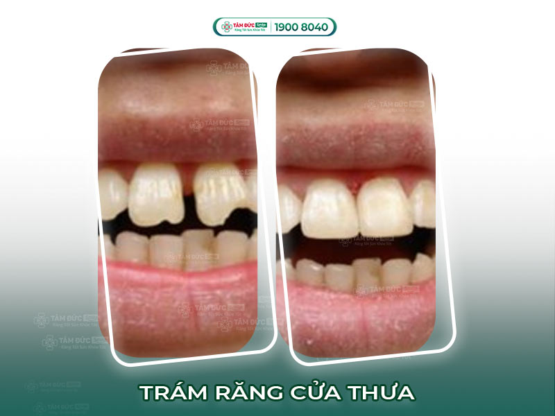  TRÁM RĂNG CỬA THƯA THẨM MỸ CÓ ĐAU KHÔNG?