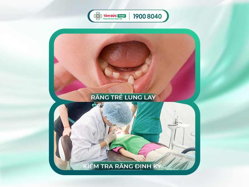 TRẺ EM CÓ RĂNG LUNG LAY BAO LÂU THÌ RỤNG? LƯU Ý GÌ KHI NHỔ RĂNG CHO TRẺ?