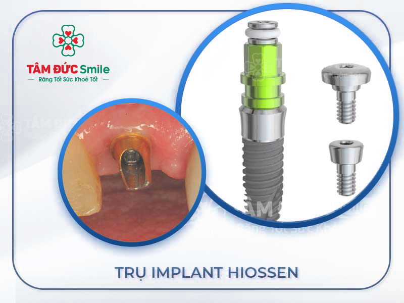 TRỤ IMPLANT HIOSSEN: XUẤT XỨ VÀ ƯU ĐIỂM ĐÁNG ĐỒNG TIỀN