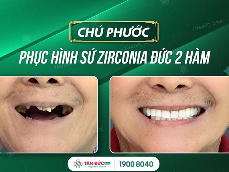 Tuổi thọ và độ bền răng toàn sứ zirconia có cao không?