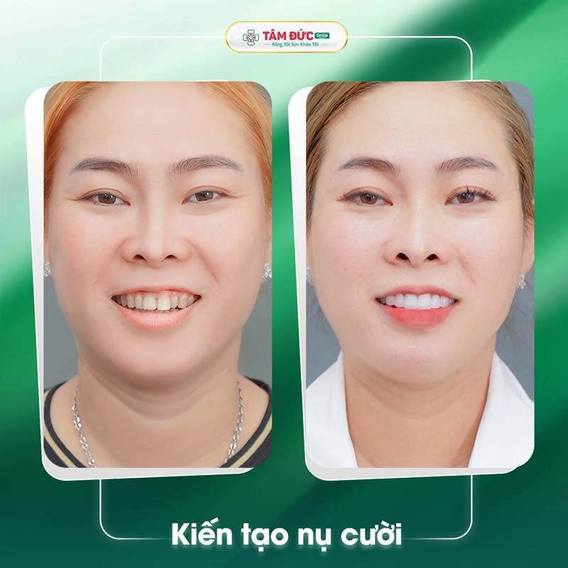 Hình ảnh khách hàng bọc răng sứ tại Tâm Đức Smile