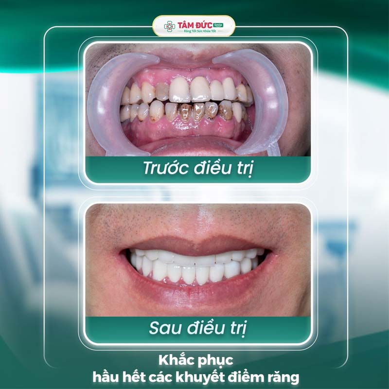 hình ảnh trước và sau khi bọc răng sứ tại nha khoa Tâm Đức Smile