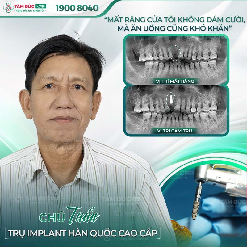 khách hàng trồng răng implant tại nha khoa Tâm Đức Smile