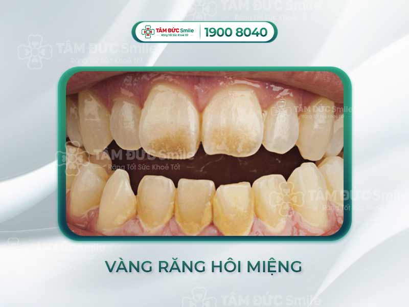 VÀNG RĂNG HÔI MIỆNG LÀ DO ĐÂU? LÀM SAO ĐỂ CẢI THIỆN?