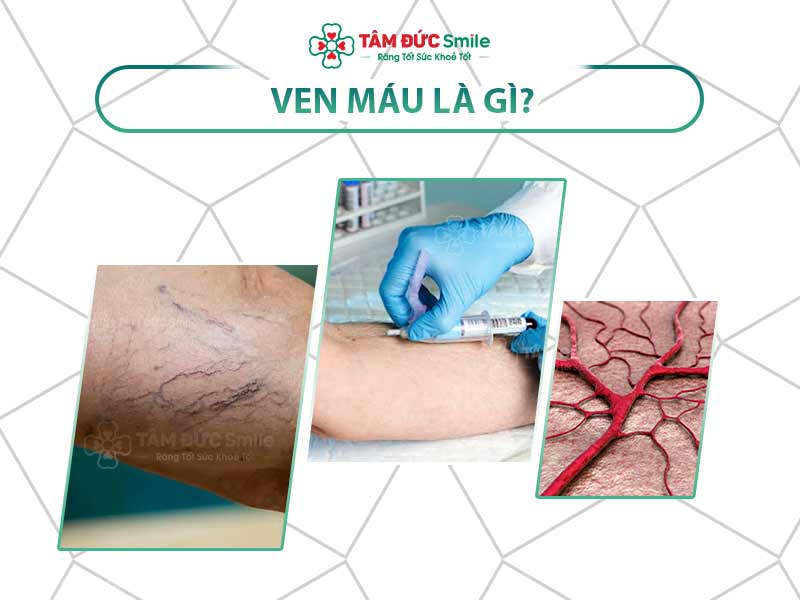 VEN MÁU LÀ GÌ? TẦM QUAN TRỌNG CỦA VIỆC XÁC ĐỊNH VEN MÁU