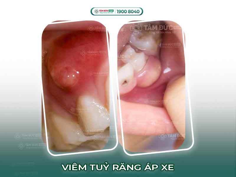 VIÊM TỦY RĂNG ÁP XE CÓ NGUY HIỂM KHÔNG? CÁCH CHỮA TRỊ AN TOÀN TRIỆT ĐỂ