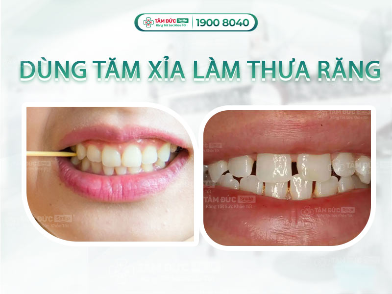 XỈA RĂNG CÓ LÀM CHO RĂNG BỊ THƯA KHÔNG? LÀM SAO ĐỂ RĂNG HẾT THƯA?