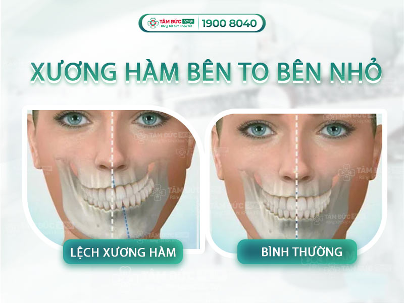 XƯƠNG HÀM BÊN TO BÊN NHỎ: NGUYÊN NHÂN VÀ CÁCH KHẮC PHỤC