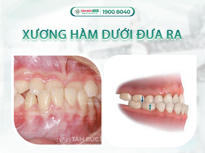 XƯƠNG HÀM DƯỚI ĐƯA RA CÓ SAO KHÔNG? NGUYÊN NHÂN VÀ CÁCH KHẮC PHỤC TRIỆT ĐỂ