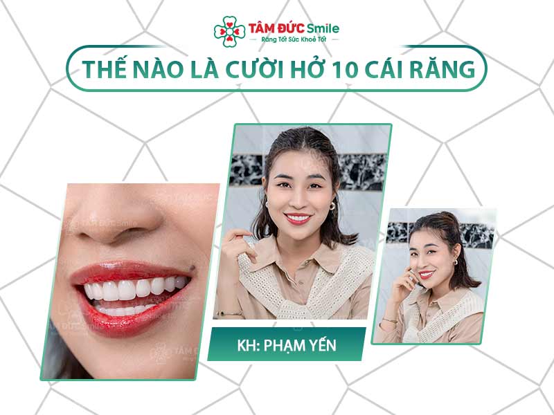 Ý NGHĨA CƯỜI HỞ 10 CÁI RĂNG LÀ GÌ? CƯỜI HỞ RĂNG LÀ ĐẸP HAY XẤU?